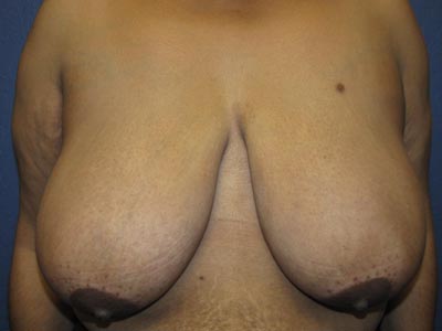 glendale breast reduction asian porn tgps